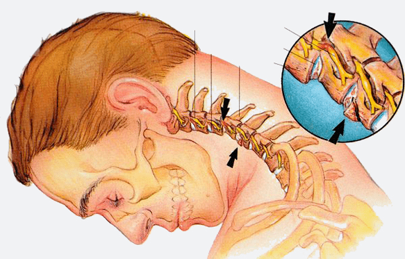 The stages of the cervical spine osteoarthritis